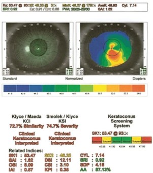 Corneal-topography-demonstrates-inferior-steepening-of-the-graft.png